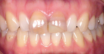 CASE01：ホワイトニング＋上の前歯2本のオールセラミック治療