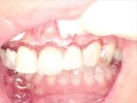 CASE02：歯周治療（レーザー治療）＋ホワイトニング＋前歯2本のオールセラミック治療