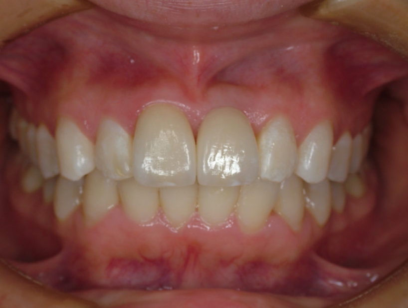 【症例1】前歯インプラント治療／下前歯矯正治療