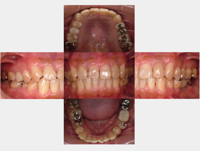 【症例2】インプラント奥歯1本