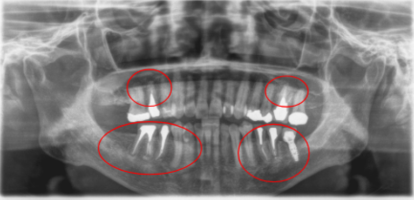 【症例4】インプラント奥歯1本・根管治療6歯