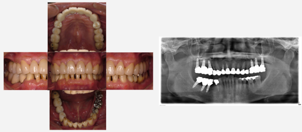2023年12月　上顎残存歯最終補綴処置終了後　約2年経過