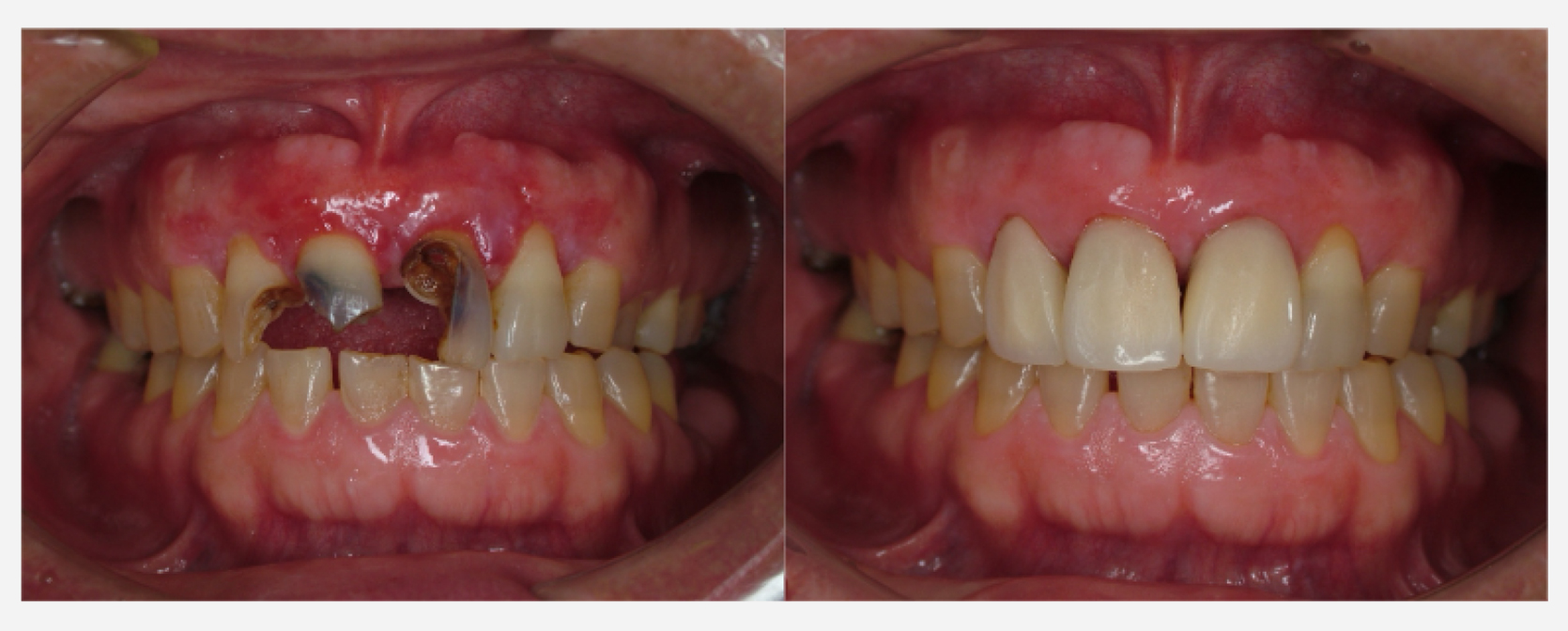 術後３ヶ月　仮歯装着