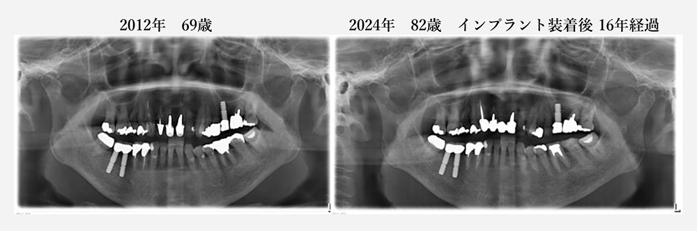 現在82歳の女性