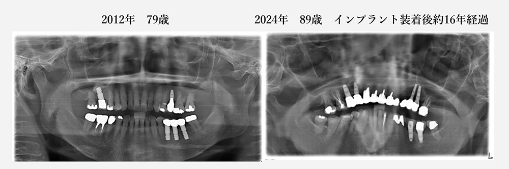 現在89歳の女性