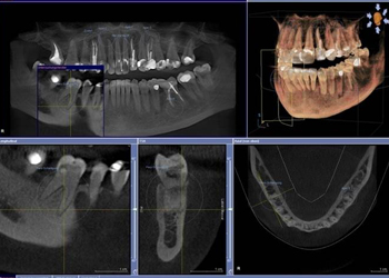 歯科用CTで正確な分析・シミュレーション