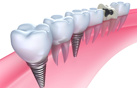 インプラント治療はほかの歯を守るために行う治療と考えています
