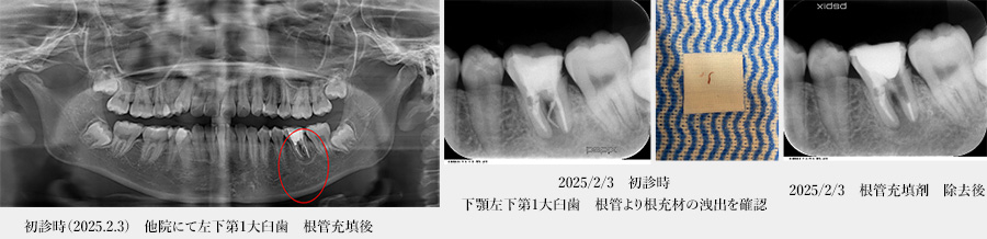 【症例4】感染根管治療
