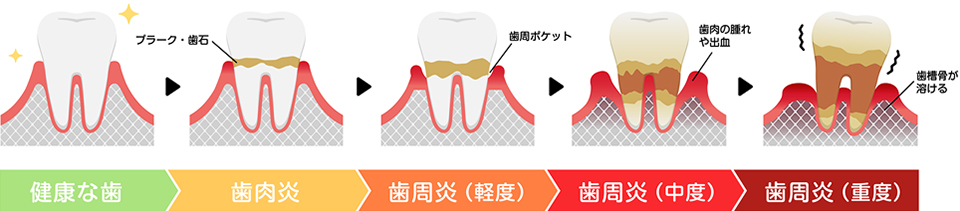 歯周病の進行段階に応じた治療を行います