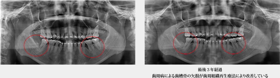 【症例１】歯周組織再生療法