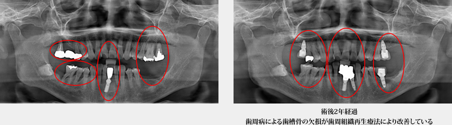 【症例４】歯周組織再生療法